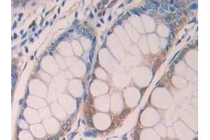 Detection of LOXL4 in Human Colorectal cancer Tissue using Polyclonal Antibody to Lysyl Oxidase Like Protein 4 (LOXL4)