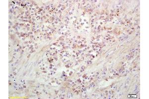 Formalin-fixed and paraffin embedded human lung carcinoma labeled with Rabbit Anti Kinesin Polyclonal Antibody, Unconjugated  at 1:200 followed by conjugation to the secondary antibody and DAB staining (Kinesin anticorps  (AA 561-660))