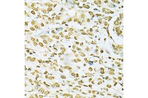 Immunohistochemistry of paraffin-embedded human gastric cancer using HNRNPA2B1 Antibody. (HNRNPA2B1 anticorps  (AA 1-180))