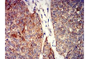 Immunohistochemical analysis of paraffin-embedded bladder cancer tissues using GRIK4 mouse mAb with DAB staining.