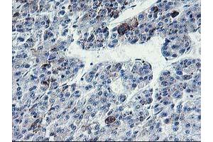 Immunohistochemical staining of paraffin-embedded Carcinoma of Human liver tissue using anti-PVRL1 mouse monoclonal antibody. (PVRL1 anticorps)