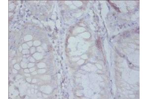 Immunohistochemistry of paraffin-embedded human colon cancer using ABIN7142508 at dilution of 1: 50 (RPS19 anticorps  (AA 1-145))