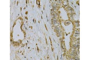 Immunohistochemistry of paraffin-embedded Human liver cancer using CDA Polyclonal Antibody at dilution of 1:100 (40x lens). (CDA anticorps)