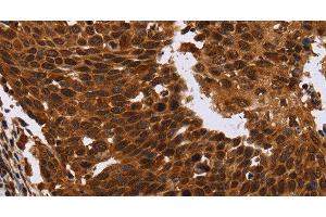 Immunohistochemistry of paraffin-embedded Human cervical cancer tissue using FANCF Polyclonal Antibody at dilution 1:60 (FANCF anticorps)