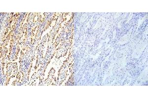 Immunohistochemical analysis of paraffin- embedded human lung carcinoma tissue using LKB1 (Ab-334) antibody (E022045). (LKB1 anticorps)
