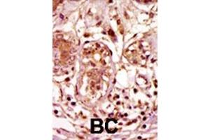 Formalin-fixed and paraffin-embedded human cancer tissue reacted with the primary antibody, which was peroxidase-conjugated to the secondary antibody, followed by AEC staining.