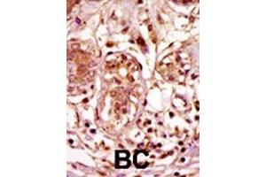 Formalin-fixed and paraffin-embedded human cancer tissue reacted with the primary antibody, which was peroxidase-conjugated to the secondary antibody, followed by AEC staining. (BUB1 anticorps  (C-Term))