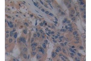 Detection of TLR9 in Human Breast cancer Tissue using Polyclonal Antibody to Toll Like Receptor 9 (TLR9)