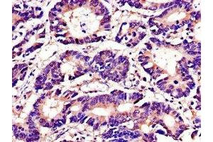 Immunohistochemistry of paraffin-embedded human colon cancer using ABIN7173671 at dilution of 1:100 (TUBA4A anticorps  (AA 20-183))