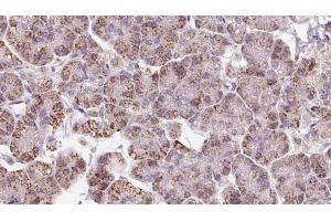 ABIN6273237 at 1/100 staining Human pancreas cancer tissue by IHC-P.