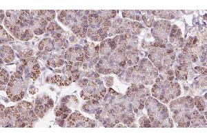 ABIN6273237 at 1/100 staining Human pancreas cancer tissue by IHC-P.