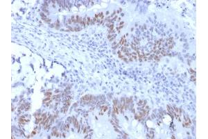Formalin-fixed, paraffin-embedded human Colon Carcinoma stained with Retinoblastoma Recombinant Rabbit Monoclonal Antibody (RB1/2313R). (Recombinant Retinoblastoma 1 anticorps)