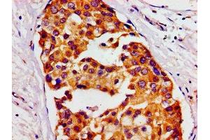 Immunohistochemistry of paraffin-embedded human breast cancer using ABIN7155948 at dilution of 1:100 (HMMR anticorps  (AA 478-653))