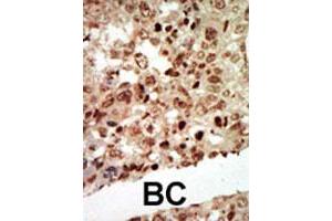 Formalin-fixed and paraffin-embedded human cancer tissue reacted with MAPK11 polyclonal antibody  , which was peroxidase-conjugated to the secondary antibody, followed by AEC staining. (MAPK11 anticorps  (Internal Region))