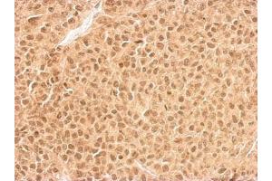 IHC-P Image RPL11 antibody detects RPL11 protein at cytosol and nucleus on HeLa xenograft by immunohistochemical analysis. (RPL11 anticorps)