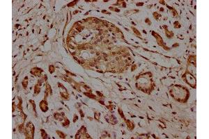 IHC image of ABIN7157636 diluted at 1:100 and staining in paraffin-embedded human pancreatic cancer performed on a Leica BondTM system. (KIF25 anticorps  (AA 1-262))