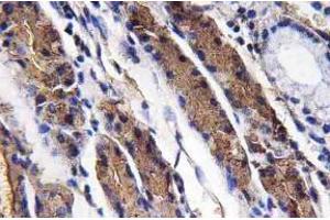 Immunohistochemistry analysis of Pepsin A Antibody in paraffin-embedded human lung carcinoma tissue. (Pepsin anticorps)
