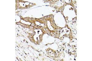 Immunohistochemistry of paraffin-embedded human colon carcinoma using  Rabbit pAb (ABIN7265370) at dilution of 1:50 (40x lens).