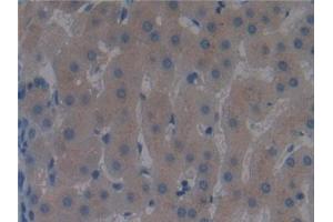 Detection of DBP in Human Liver cancer Tissue using Polyclonal Antibody to Vitamin D Binding Protein (DBP)