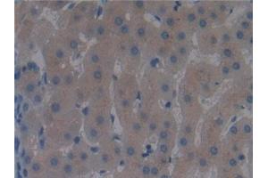 Detection of DBP in Human Liver cancer Tissue using Polyclonal Antibody to Vitamin D Binding Protein (DBP) (Vitamin D-Binding Protein anticorps  (AA 395-474))