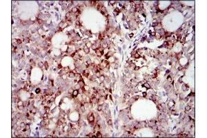 Immunohistochemical analysis of paraffin-embedded cervical cancer tissues using PIK3R1 mouse mAb with DAB staining.