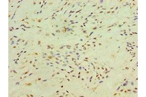 Immunohistochemistry of paraffin-embedded human breast cancer using ABIN7150305 at dilution of 1:100 (XRCC4 anticorps  (AA 1-336))