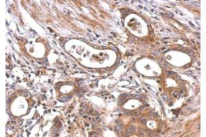 IHC-P Image MC1 Receptor antibody [C2C3], C-term detects MC1R protein at cytosol and membrane on human colon carcinoma by immunohistochemical analysis.