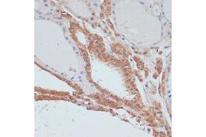 Immunohistochemistry of paraffin-embedded human thyroid cancer using MYCBP antibody (ABIN1680940, ABIN3019105, ABIN3019106 and ABIN6220717) at dilution of 1:100 (40x lens). (MYCBP anticorps  (AA 1-103))