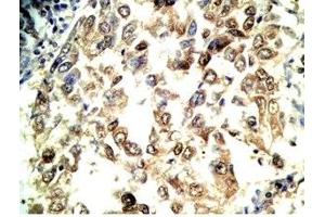 Human lung cancer tissue stained by Rabbit Anti-Adrenomedullin Gly (Human) Antibody (Adrenomedullin-Gly anticorps)