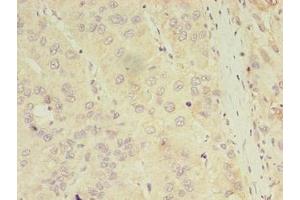 Immunohistochemistry of paraffin-embedded human liver cancer using ABIN7144179 at dilution of 1:100