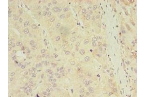 Immunohistochemistry of paraffin-embedded human liver cancer using ABIN7144179 at dilution of 1:100 (ASB11 anticorps  (AA 41-315))