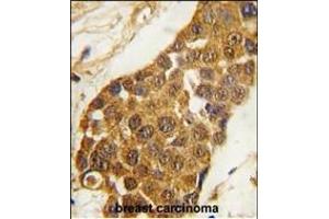 Formalin-fixed and paraffin-embedded human breast carcinoma tissue reacted with Msx2 Antibody (C-term) (ABIN1881555 and ABIN2839326) , which was peroxidase-conjugated to the secondary antibody, followed by DAB staining.