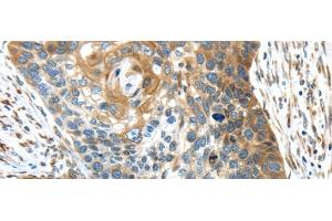 Immunohistochemistry of paraffin-embedded Human esophagus cancer using TMED4 Polyclonal Antibody at dilution of 1/45 (TMED4 anticorps)