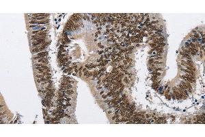 Immunohistochemistry of paraffin-embedded Human colon cancer tissue using CMTM2 Polyclonal Antibody at dilution 1:60 (CMTM2 anticorps)