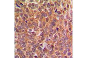 Immunohistochemical analysis of EIF2S1 (pS51) staining in human breast cancer formalin fixed paraffin embedded tissue section.