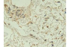 Detection of NRP1 in Human Breast cancer Tissue using Polyclonal Antibody to Neuropilin 1 (NRP1) (Neuropilin 1 anticorps  (AA 646-814))