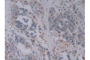 IHC-P analysis of Human Breast cancer Tissue, with DAB staining. (GZMB anticorps  (AA 21-247))
