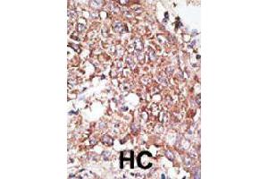 Formalin-fixed and paraffin-embedded human hepatocellular carcinoma tissue reacted with LYVE1 polyclonal antibody  , which was peroxidase-conjugated to the secondary antibody, followed by DAB staining. (LYVE1 anticorps  (C-Term))
