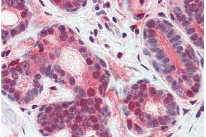 Human Breast (formalin-fixed, paraffin-embedded) stained with ATF6 antibody ABIN351433 at 5 ug/ml followed by biotinylated goat anti-rabbit IgG secondary antibody ABIN481713, alkaline phosphatase-streptavidin and chromogen. (ATF6 anticorps  (N-Term))