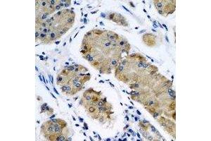 Immunohistochemical analysis of OPA3 staining in human gastric cancer formalin fixed paraffin embedded tissue section. (OPA3 anticorps)