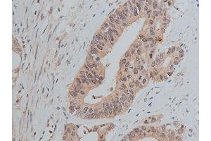 ABIN6256758 and ABIN6267373 at 1/50 staining human colon carcinoma tissue sections by IHC-P. (Src anticorps  (pTyr530))