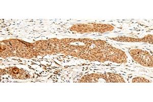 Immunohistochemistry of paraffin-embedded Human esophagus cancer tissue using GTF3A Polyclonal Antibody at dilution of 1:60(x200)