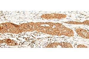 Immunohistochemistry of paraffin-embedded Human esophagus cancer tissue using GTF3A Polyclonal Antibody at dilution of 1:60(x200) (GTF3A anticorps)