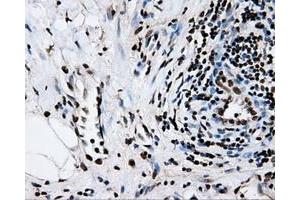 Immunohistochemical staining of paraffin-embedded Adenocarcinoma of colon tissue using anti-RPA2mouse monoclonal antibody. (RPA2 anticorps)