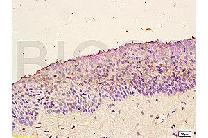 Formalin-fixed and paraffin embedded: human nasopharyngeal carcinoma labeled with Anti-Trk-B Polyclonal Antibody (ABIN725870), Unconjugated at 1:200 followed by conjugation to the secondary antibody and DAB staining