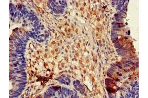 Immunohistochemistry of paraffin-embedded human ovarian cancer using ABIN7149934 at dilution of 1:100 (DPYSL4 anticorps  (AA 280-560))