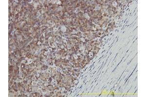 Immunoperoxidase of monoclonal antibody to GALT on formalin-fixed paraffin-embedded human lymphoma tissue.