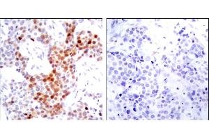 Immunohistochemical analysis of paraffin-embedded breast carcinoma. (ATF2 anticorps  (pThr51, pThr69))