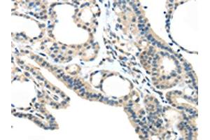 The image on the left is immunohistochemistry of paraffin-embedded Human thyroid cancer tissue using ABIN7193032(VSIG10 Antibody) at dilution 1/45, on the right is treated with synthetic peptide.