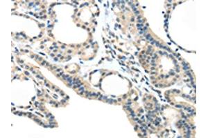 The image on the left is immunohistochemistry of paraffin-embedded Human thyroid cancer tissue using ABIN7193032(VSIG10 Antibody) at dilution 1/45, on the right is treated with synthetic peptide. (VSIG1 anticorps)